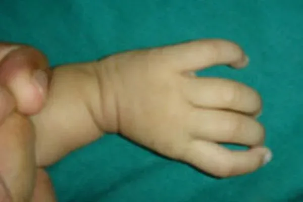 Case 8, Absent Thumb, Surgery at 7 Months, clinical photograph
