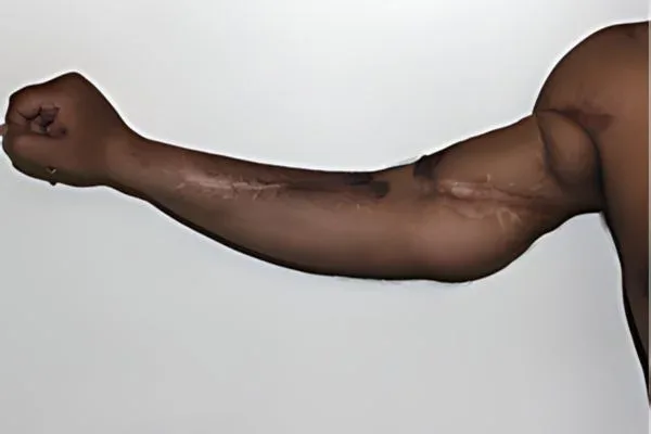 Case 14, Reattachment of a Completely Severed Arm, clinical photograph