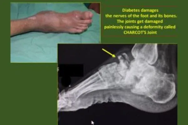 Case 6, Diabetic Foot / Charcot Foot / Burning Sole, clinical photograph