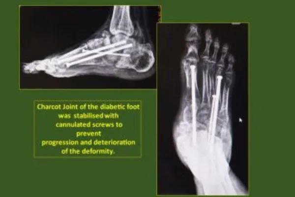 Case 6, Diabetic Foot / Charcot Foot / Burning Sole, clinical photograph