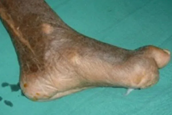 Case 7, Diabetic Foot, Non-healing Sole Wound, clinical photograph