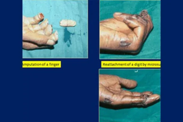 Case 4, Injury & Finger Amputation, clinical photograph