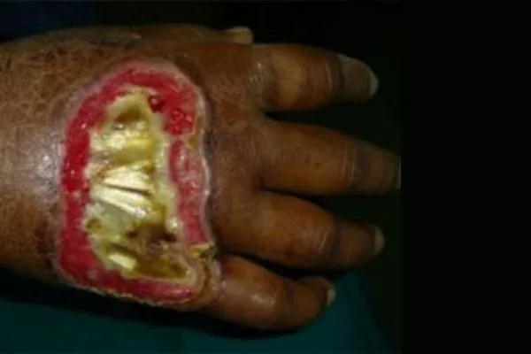 Case 2, Finger Flap Surgery, PIA Flap, clinical photograph