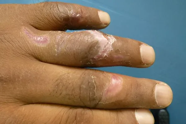 Case 3, Finger Flap Surgery, Transposition Flap, clinical photograph