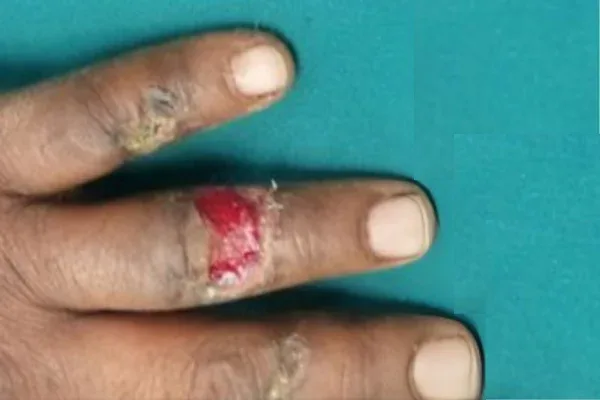 Case 3, Finger Flap Surgery, Transposition Flap, clinical photograph