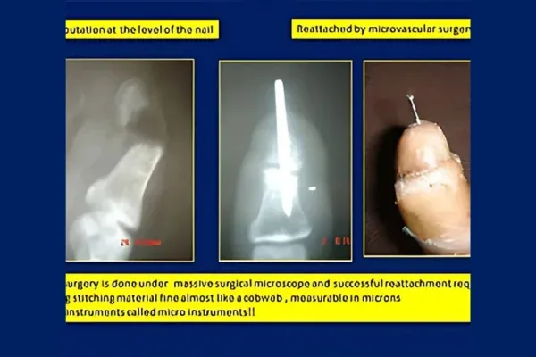 Case 5, Amputation at the Level of the Nail, clinical photograph