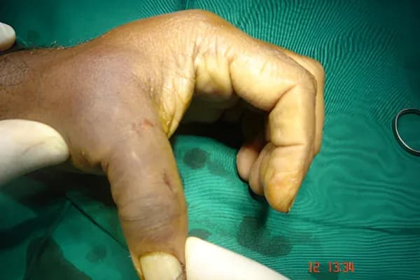 Case 15, Gamekeeper's Thumb, clinical photograph