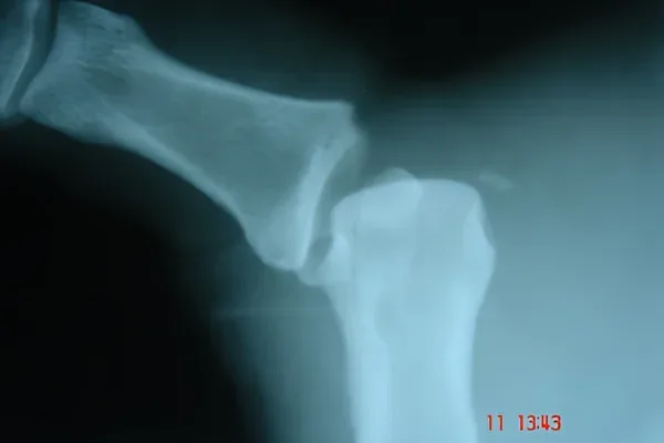 Case 15, Gamekeeper's Thumb, clinical photograph