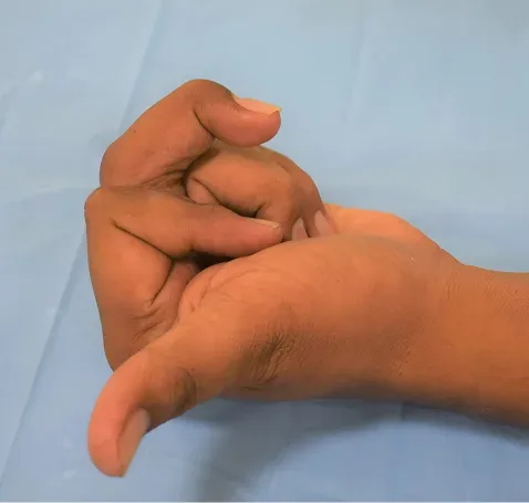 Case 17, Jammed Finger After Cricket Ball Injury, clinical photograph
