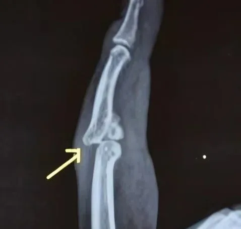 Case 17, Jammed Finger After Cricket Ball Injury, clinical photograph