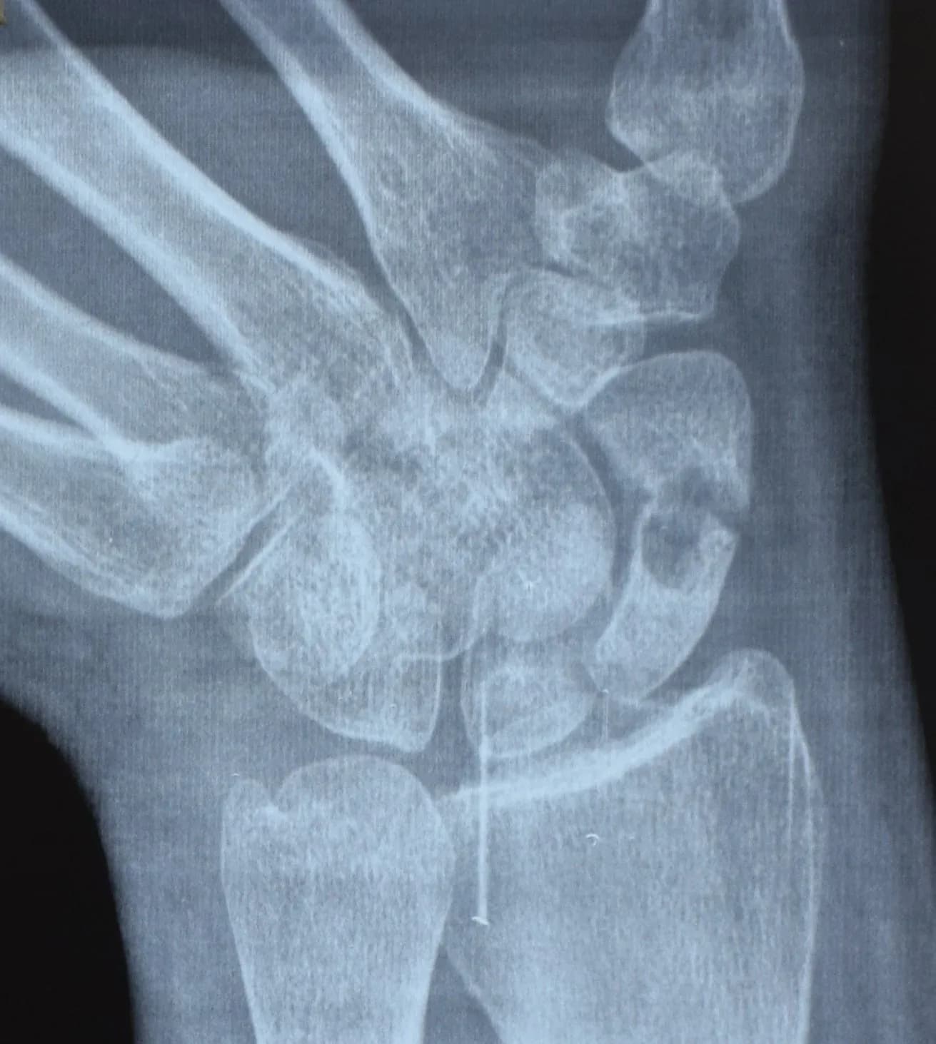 Case 16, Scaphoid (Wrist) Fracture, clinical photograph