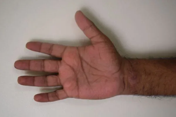 Slashed Wrist, clinical photograph 1