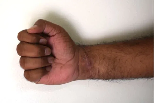 Slashed Wrist, clinical photograph 2