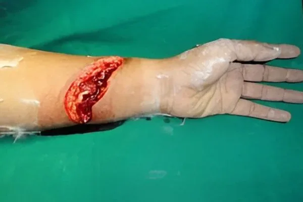 Slashed Wrist, clinical photograph 3