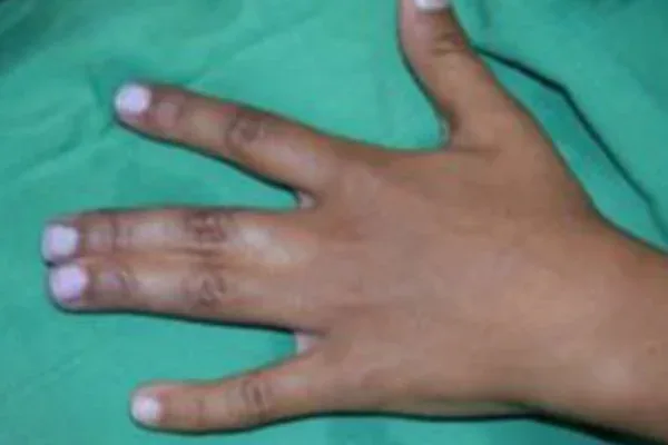 Case 13, Syndactyly, One Year After Separation, clinical photograph