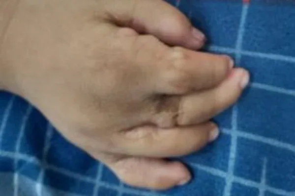 Case 12, Syndactyly, Web Creation, clinical photograph