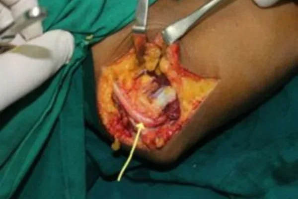 Case 10, Ulnar Nerve Compression at the Elbow, clinical photograph