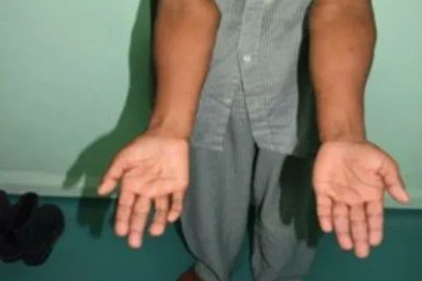 Case 11, Ulnar Nerve Stretch after Old Elbow Fracture, clinical photograph