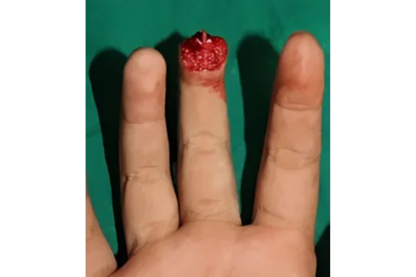 Clinical photograph, Hand Trauma & Fractures