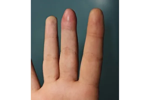 Clinical photograph, Hand Trauma & Fractures