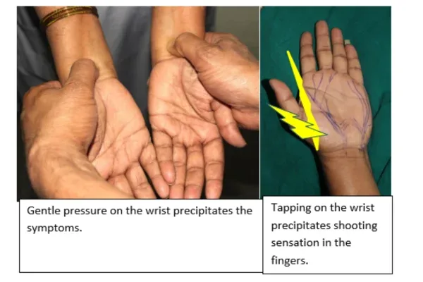 Clinical photograph, Numbness & Tingling (Nerve Compression)