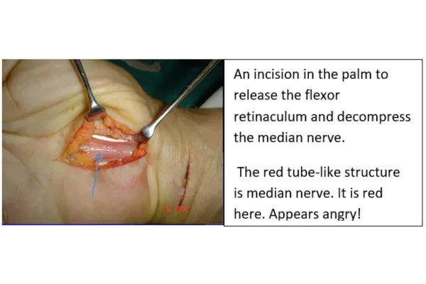 Clinical photograph, Numbness & Tingling (Nerve Compression)