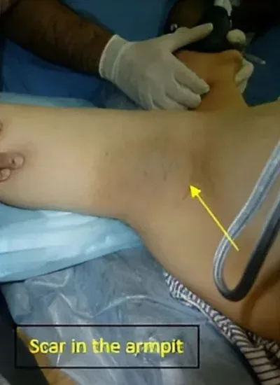 Clinical photograph, Numbness & Tingling (Nerve Compression)