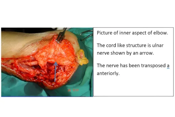 Clinical photograph, Numbness & Tingling (Nerve Compression)