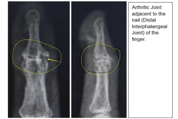 Clinical photograph, Hand & Wrist Pain and Arthritis