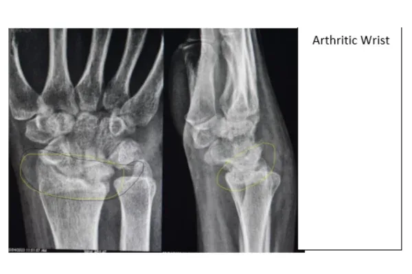 Clinical photograph, Hand & Wrist Pain and Arthritis