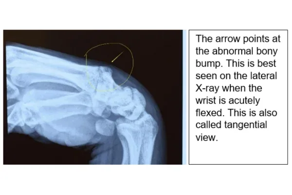 Clinical photograph, Hand & Wrist Pain and Arthritis