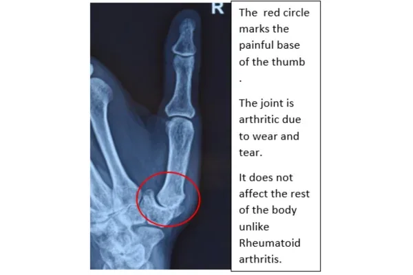Clinical photograph, Hand & Wrist Pain and Arthritis