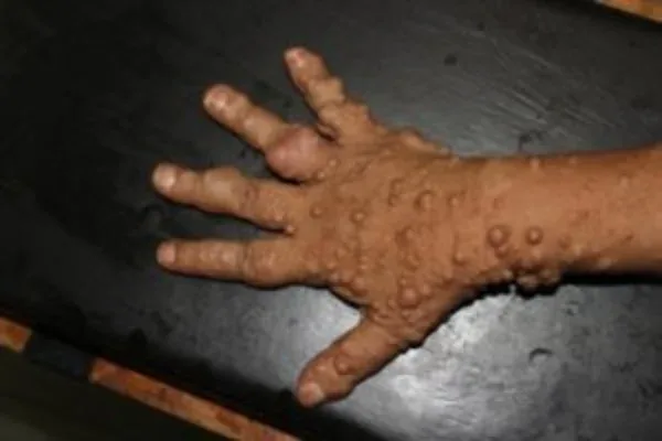 Clinical photograph, Hand & Wrist Pain and Arthritis