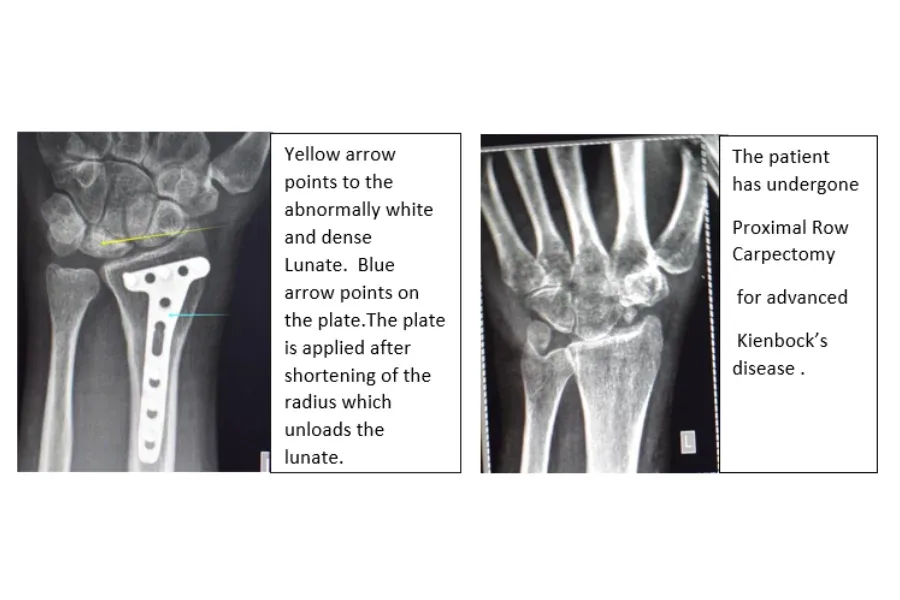 Clinical photograph, Hand & Wrist Pain and Arthritis