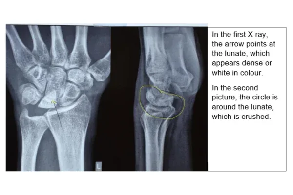 Clinical photograph, Hand & Wrist Pain and Arthritis