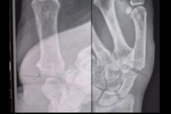 Clinical photograph, Hand & Wrist Pain and Arthritis
