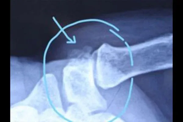 Clinical photograph, Hand & Wrist Pain and Arthritis