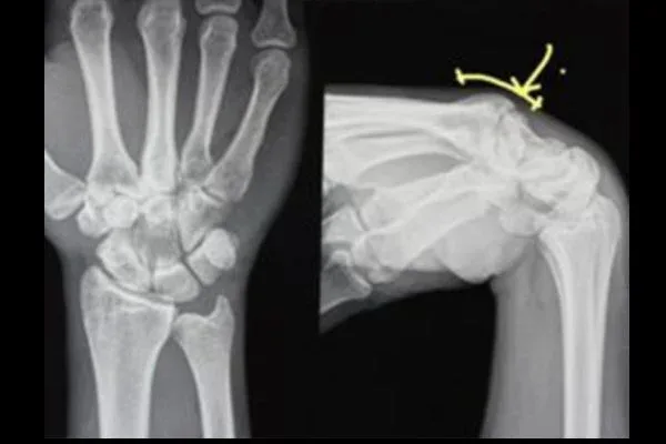 Clinical photograph, Hand & Wrist Pain and Arthritis