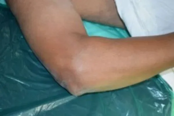 Clinical photograph, Hand & Wrist Pain and Arthritis