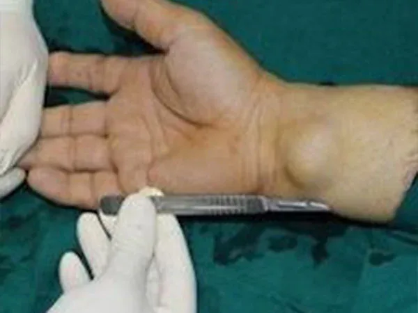 Clinical photograph, Hand Tumours & Swelling