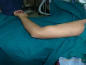 Clinical photograph, Hand Tumours & Swelling
