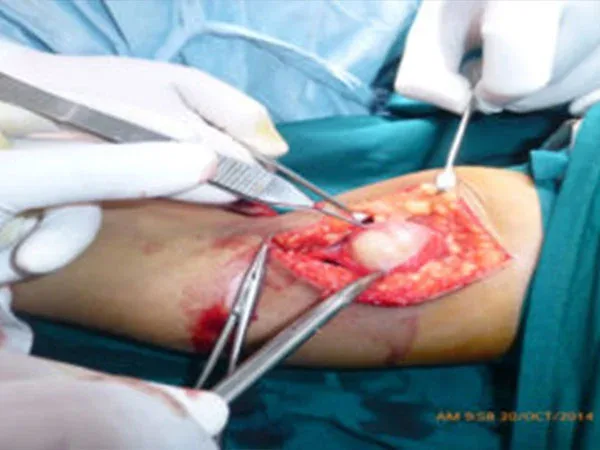 Clinical photograph, Hand Tumours & Swelling