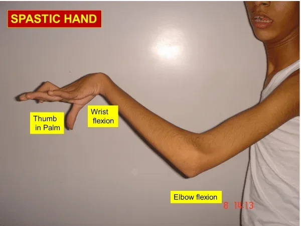 Clinical photograph, Paralysis & Spastic Hand