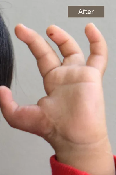 Clinical photograph, Congenital Hand Differences