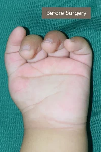 Clinical photograph, Congenital Hand Differences