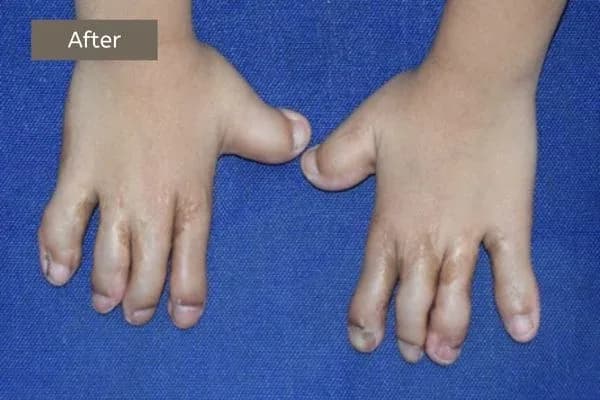 Clinical photograph, Congenital Hand Differences
