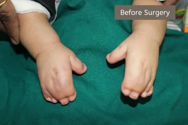 Clinical photograph, Congenital Hand Differences