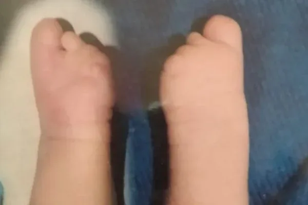 Clinical photograph, Congenital Hand Differences