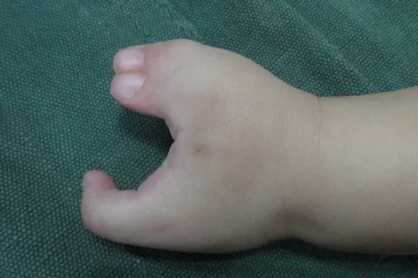 Clinical photograph, Congenital Hand Differences