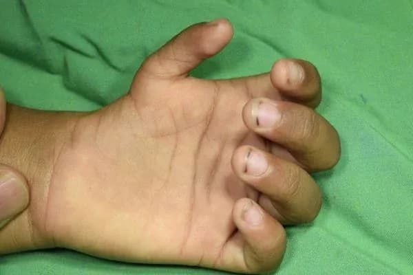 Clinical photograph, Congenital Hand Differences